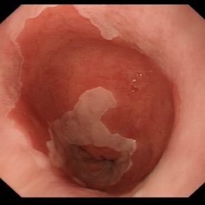 An image of Barrett's oesophagus. The salmon red lining of the oesophagus has replaced the normal pink lining. This is a low risk pre-cancerous abnormality that is diagnosed during endoscopy. 