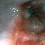 severe-oesophagitis2x